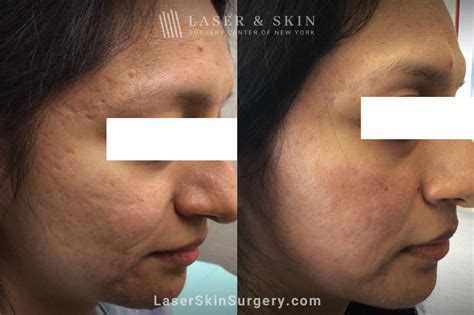 acneclinicnyc|best acne scar treatment nyc.